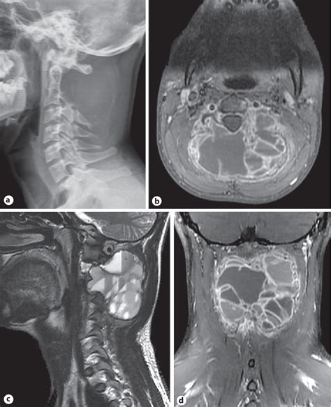 Figure 1 From Pediatric Cervical Aneurysmal Bone Cyst Treated By