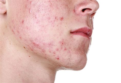 انواع جوش صورت و روش‌های درمان آنها ویرگول