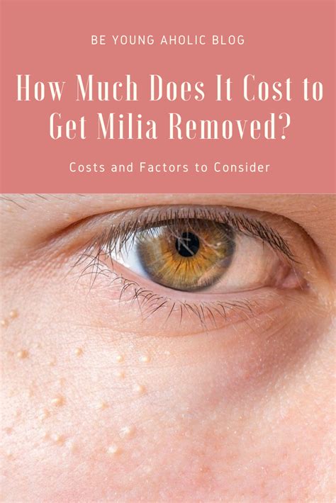 How To Remove Milia Dermatologist Howotre