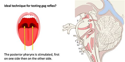 Pulmcrit The Gag Reflex Shouldnt Be Tested In Living Patients