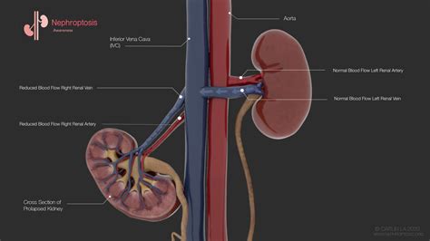 Rare Kidney Condition Explored Through Medical Illustrations And