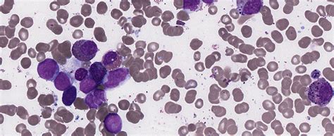Acute Myeloid Leukemia Inv16 Bone Marrow Squash Film