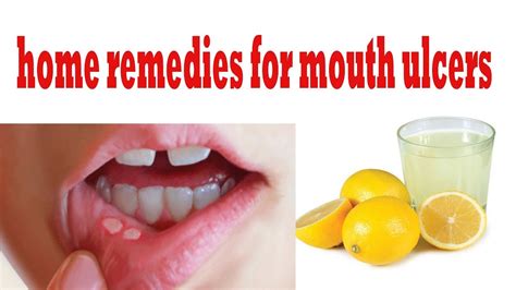 Read on to get full details about tips to get rid of way tongue problem. 😰 ulcers in mouth - how to get rid of mouth ulcers || How ...