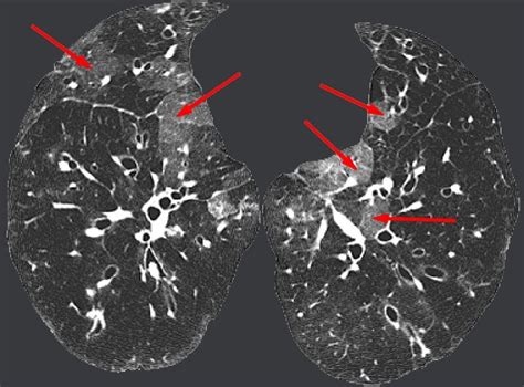 E Ct Scan Hrct Lungs Mosaic Attenuation