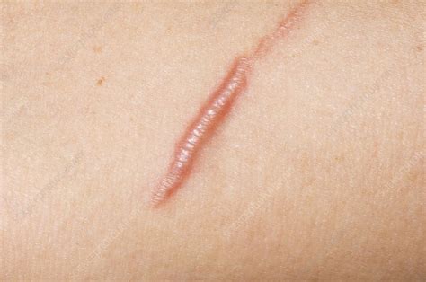 Keloid Scar From A Cat Scratch Stock Image C0090128 Science