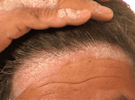 Scalp And Hair Disorder Treatment Program