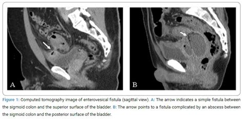 Bladder Fistula Resection And Separation For Enterovesical Fistula Due To Sigmoid Colon