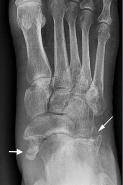 Pdf Unusual Variant Of The Nutcracker Fracture Of The Calcaneus And