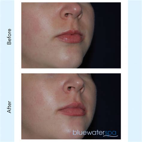 The Botox® Lip Flip Blue Water Spa Raleigh Brier Creek