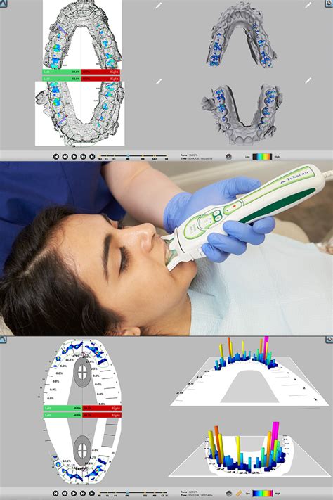 Dental Scan With T Scan Tekscan