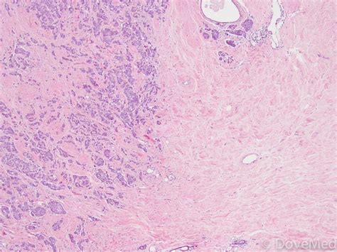 Invasive Ductal Carcinoma Stages