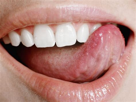 Small Big Sore Red Spots On Tongue Cause And Meaning American Celiac