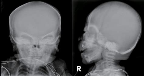 Skull Radiographs Showing Underossification Of The Calvarium