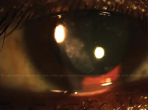 Treatment Of Recurrent Corneal Erosions American Academy Of Ophthalmology