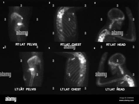 Bone Scan For Cancer Showing Multiple Metastases To The Shoulder Ribs Pelvis Humerus Femur