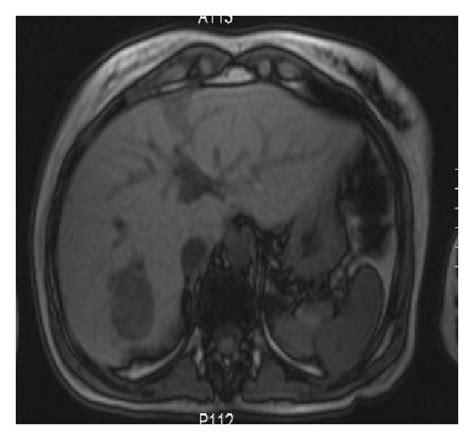 Abdominal Ct Scan With Intravenous Contrast Showing Several Hypodense