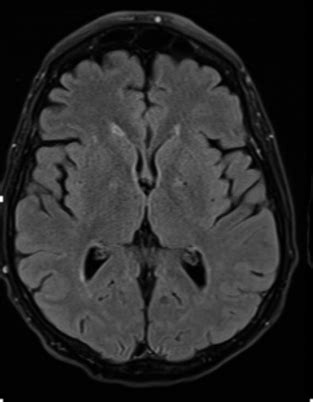 Hsv encephalitis, herpes simplex encephalitis. Fulminant Herpes Simplex Encephalitis With Normal Initial ...