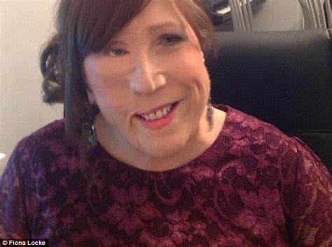 Woman Who Has Had Operations To Correct Facial Deformity Calls End To Surgery Daily Mail Online