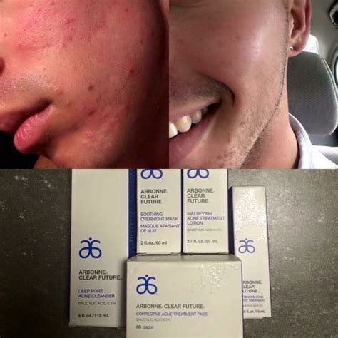 Arbonnes Clear Future Acne Line So Many Wonderful Results From 5