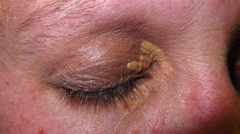 Xanthelasma Treatment Causes Photo And More