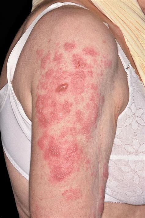 Shingles Lesions Photograph By Dr P Marazziscience Photo Library