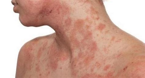Dermatitis At Pica La Enfermedad De La Piel Que Genera Depresi N Y