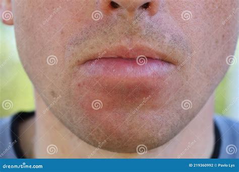 The Lower Lip Was Swollen The Face Swelled After The Bee Sting Stock