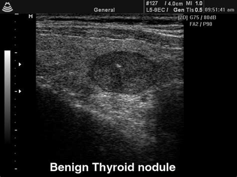 Ultrasound Images • Thyroid Benign Nodule B Mode Echogramm №139