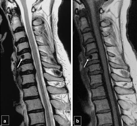 E T2 A And T1 Weighted B Sagittal Mri Images Of The Cervical Spine