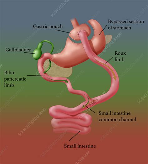 Roux En Y Gastric Bypass Surgery Illustration Stock Image C044 5835 Science Photo Library