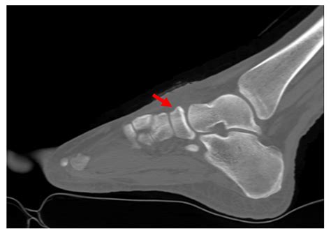 Navicular Stress Fracture Top Of Foot