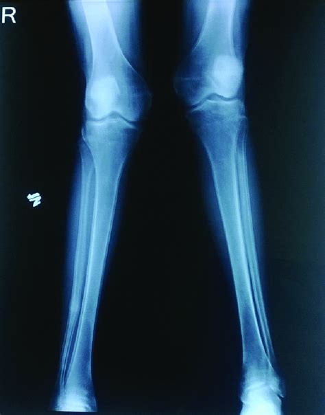 X Ray Bilateral Leg Is Showing Bilateral Genu Valgum With Double