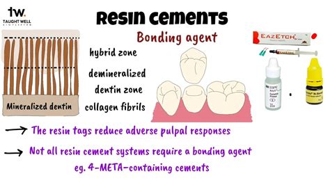 Dental Cements Compomers And Resin Cements Youtube