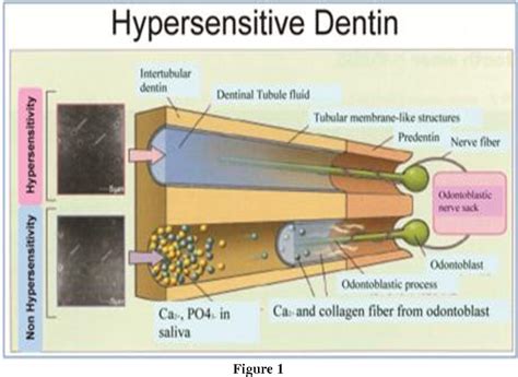 Figure 1 From Dentin Hypersensitivity Pathogenisis And Management Dr