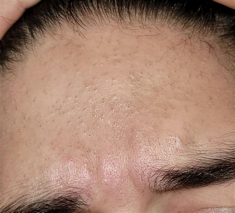 [Routine help] these blackheads have been in my forehead for quite a