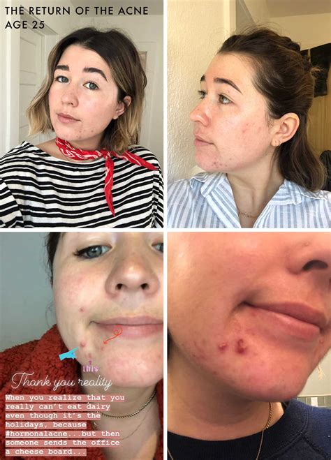 How Sara Saved Her Skin Finally Cured Her Adult Acne Emily Henderson