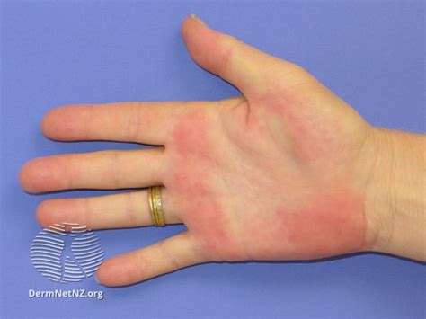 Clinical Signs Of The Hands Geeky Medics