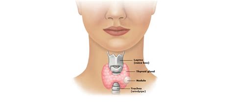 Goiter Removal