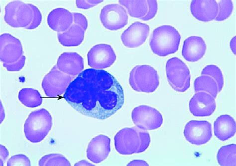 Peripheral Blood Smear The Arrow Is Pointing To A Flower Cell Which