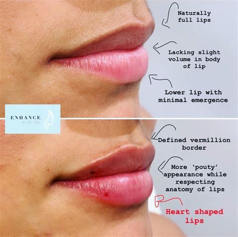 dermal fillers lips face fillers botox fillers lip injections juvederm botox lips heart