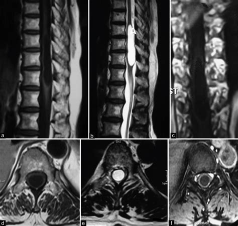 Lesions On Mri T Spine