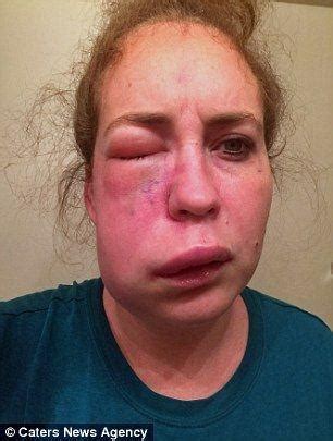 Arteriovenous Malformation Facial New Porn Comments