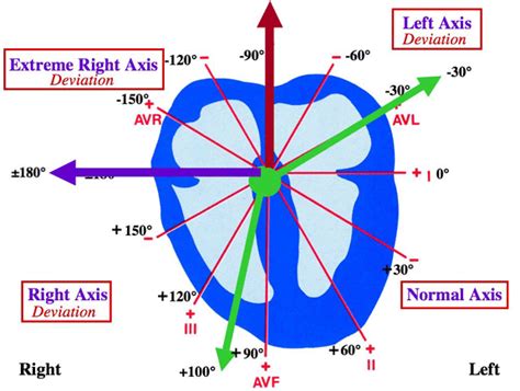 Right axis deviation is said to be present if the major qrs vector is between +90 and +180 degrees. Hexaxial reference system