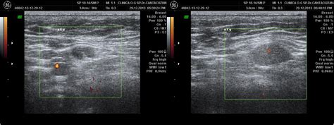 Ultrasound Axillary Imaging Intechopen