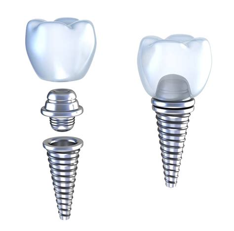 What Is Dental Implant Abutment Types And Cost