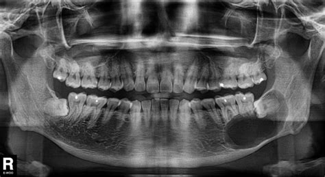 Wisdom Teeth Minor Oral Surgery Medical Orofacial Surgery