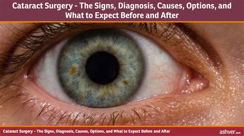 Cataract Surgery The Signs Diagnosis Causes Options And What To