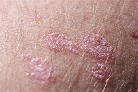 Causes Of Itchy Skin With No Rash What It Can Reveal