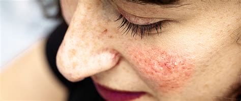 In her thirties she was diagnosis with acne rosacea by a dermatologist. Rosazea - Dr. Kuhr - Präventionsmedizin & Ästhetische ...
