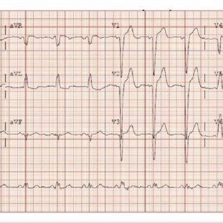 12 Lead Electrocardiogram Showing Sinus Rhythm With A Left Bundle